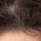 Thinning hair on scalp
